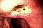 Skrandžio ir dvylikapirštės žarnos opos simptomai Lėtinės dvylikapirštės žarnos opos