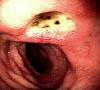 Skrandžio ir dvylikapirštės žarnos opos simptomai Lėtinės dvylikapirštės žarnos opos